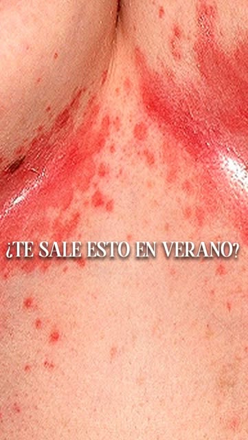 🔴 ¿Te han aparecido lesiones rojizas en los pliegues de la piel y no sabes qué son?

Podría tratars