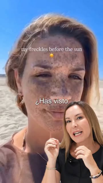 ☀️ ¿Has visto este vídeo viral? Estas manchas que vemos en su cara se llaman efélides, lo que comúnm