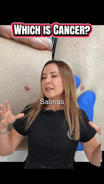 ☀️ ¿Sabrías distinguir una lesión benigna de una que necesita revisión?

Después del verano y de una