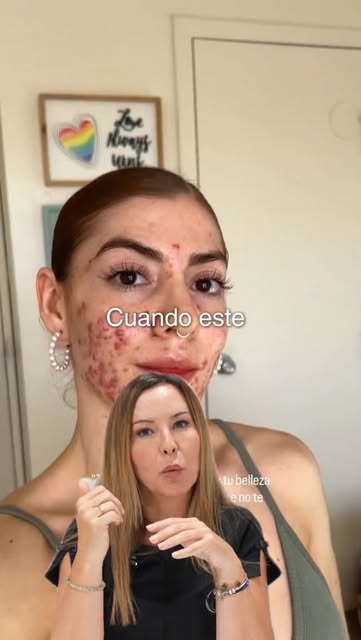🔴 Cuando aparece acné inflamatorio durante la adolescencia, no hablamos simplemente de unos granos.