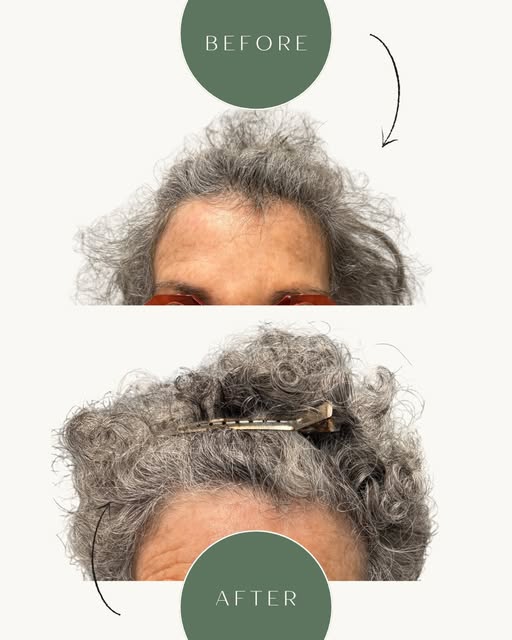 What can happen when you address hair loss at the right time?

This woman in her 70s experienced sig