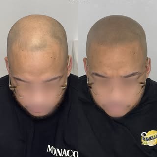 Chez Hair Ink Precision, chaque détail compte.

Réalisation d’une tricopigmentation sur 4 zones avec