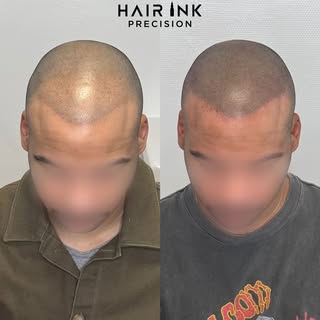Transformation sur mesure chez Hair Ink Precision

Aujourd’hui, intervention en tricopigmentation su