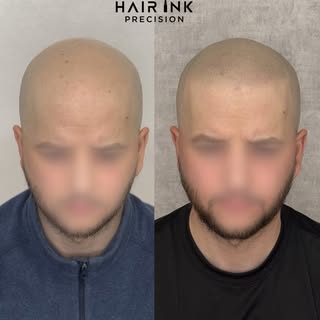 ✨ Transformation discrète, résultat naturel.

Réalisation d’une micropigmentation capillaire avec un