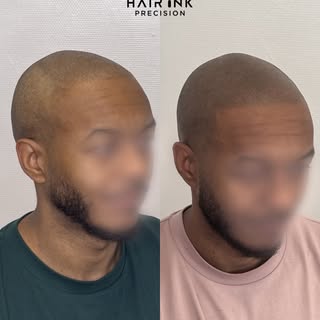 Quand la greffe ne donne pas le résultat attendu et que la pigmentation précédente manque de naturel
