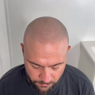 Tricopigmentation effet rasé sur 4 zones , chez hair ink precision nous prenons le temps d’adapter e