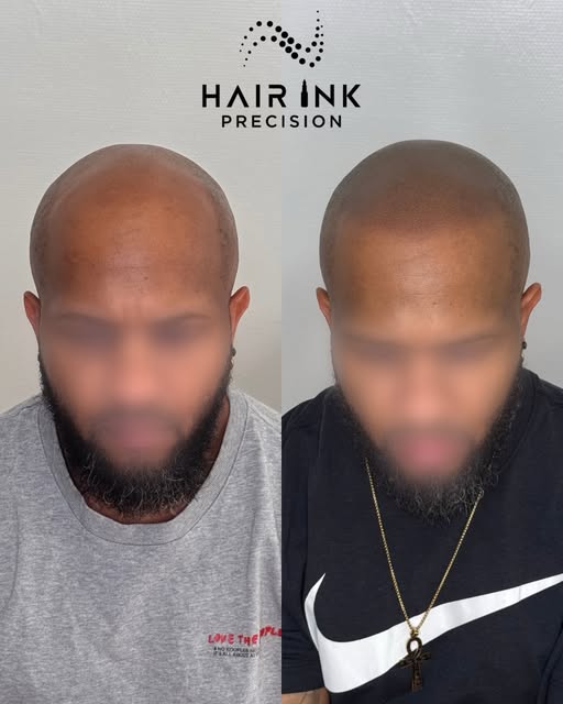 Tricopigmentation réalisée sur 3 zones 

L’objectif ici : retrouver une impression de densité tout e
