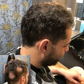 An instant solution for people who experience alopecia is to attach the balding area with hair patch