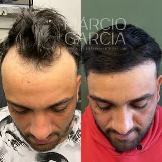 Um caso real de acompanhamento após transplante capilar pela técnica FUE, realizado após uma avaliaç