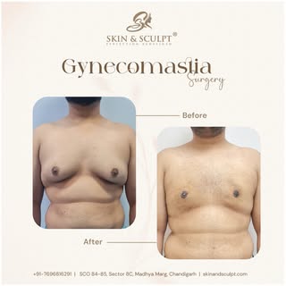 Discover effective and long-lasting solutions for male breast development right here in Chandigarh. 