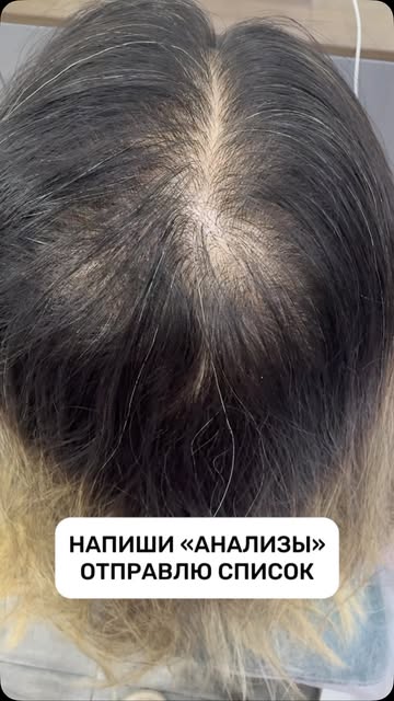 На этом видео хорошо видно, к чему может привести ситуация, когда выпадение волос долго остаётся без