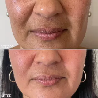 The Cosmelan Peel is a professional depigmentation treatment designed to target the root cause of pi