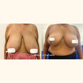 Feeling weighed down by heavy breasts, bra strap grooves, and constant back or neck pain? 💭 
Breast