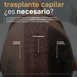 ¿Te has preguntado cuándo el trasplante capilar es realmente necesario?
La pérdida de cabello no sol