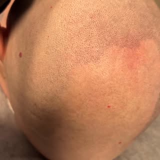 Varje punkt, Varje detalj.
Scalp Micropigmentation handlar om precision! Scalp Micropigmentation när