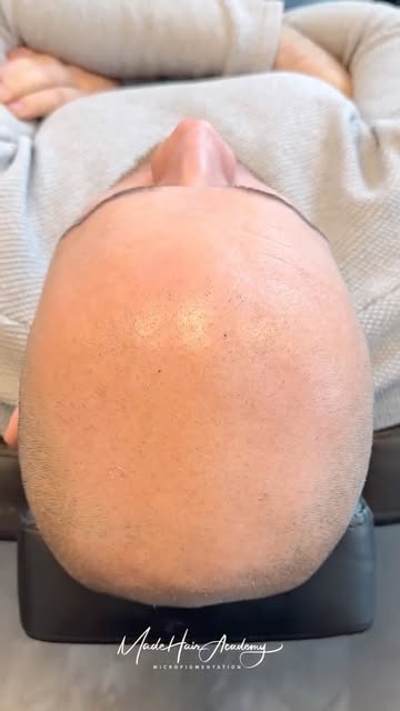 SMP är ett visuellt alternativ vid håravfall. Scalp micropigmentation kan skapa en tydligare hårlinj