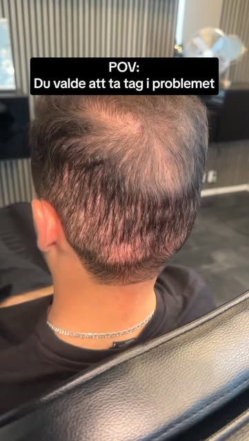 Skillnaden är brutal 😱☠️

Boka din tid via länken i bio/vår webbsida 

#madehairacademy #smp #hårta