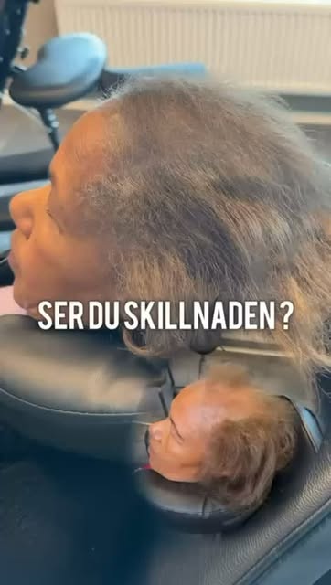 Kvinnligt håravfall kan göra benan bredare och hårbotten mer synlig. SMP kan skapa mer visuell täthe
