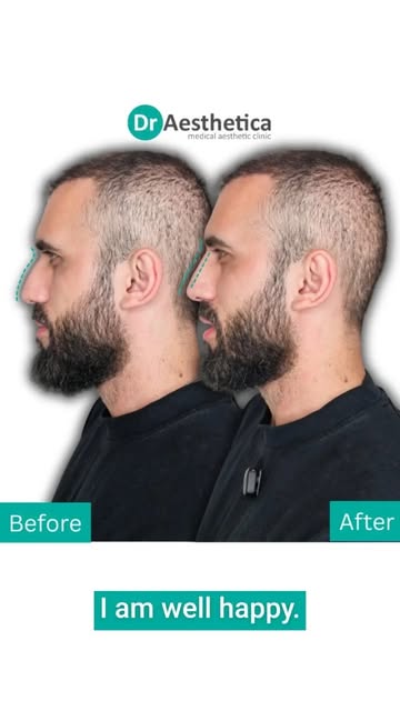 How can adding filler make a nose seem smaller? 🤔

It can seem counterintuitive until you see it. B