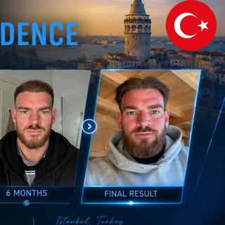 🇹🇷 NIMCLINIC | Istanbul, Türkiye

Looking for natural results, professional care, and advanced hai