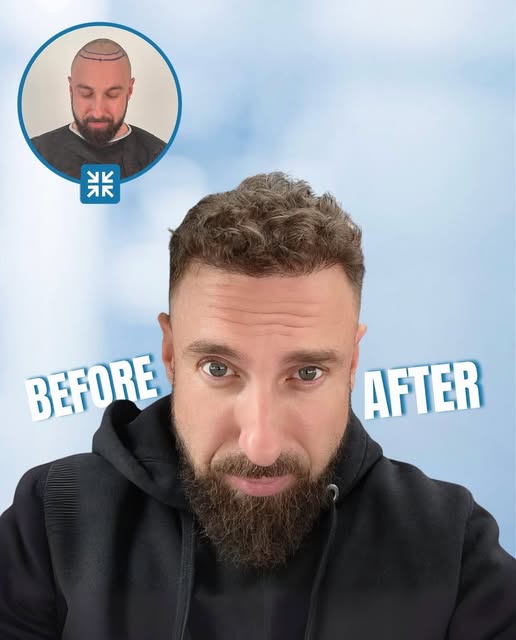 ➡️Noticeable Difference in Hair Transplant in Just 6 Months!
Turn the excitement of your first day i