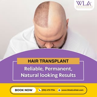A hair transplant is more than just a procedure—it's your path to regaining confidence with results 