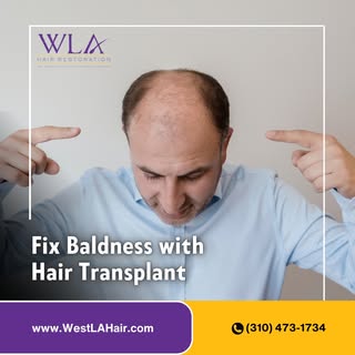 Fix baldness, restore confidence 💇‍♂️✨ 
A hair transplant is your permanent solution to hair loss. 