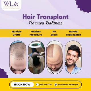 No more baldness, no scars, no pain - just natural-looking hair. 💇‍♂️✨ 
Experience a seamless hair 