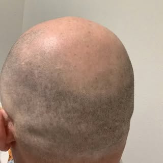 🔥 Natural Hairline Transformation with Hair Stroke SMP 🔥

Looking for the most natural Scalp Micro