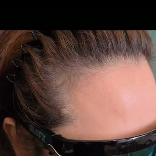 HAIRLINE RESTORATION — Slow Drag + Fast Stroke Technique ✨
Natural, undetectable hairline density us