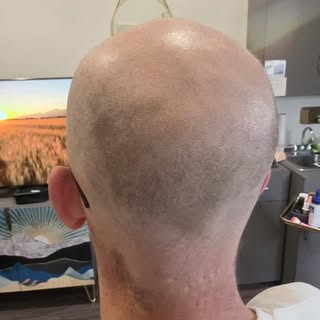 FULL SCALP SMP — The Buzzed Look, Perfected 🖤
This is what a clean, natural-looking shaved head rea