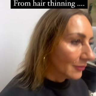 From Hair Loss to Confidence: One of our CNC Transformations here in Jersey. 

Hair loss can be life