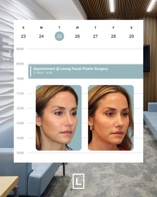 This rhinoplasty before and after shows an early look at the healing process, but the transformation