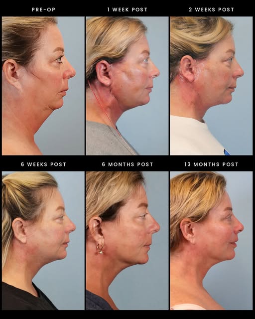 The question I get more than any other about face and neck lift healing: when am I going to look goo