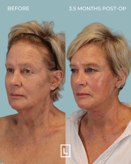 Three and a half months after a Preservation Extended Deep Plane Face & Neck Lift with an Upper Blep