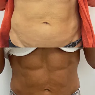 A summer body is built in winter! Check this result after only 2 sessions of Morpheus8 treatment.

A