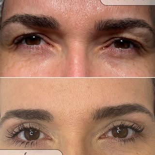 ✨ A refreshed look in one treatment ✨

Droopy eyelids can make you look tired, even when you’re not.