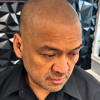 This is #scalpmicropigmentation the #number1 #hairloss solution #naturalhairline