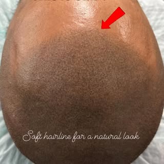 This client was suffered from #hairloss as you can see in the second picture. With #scalpmicropigmen