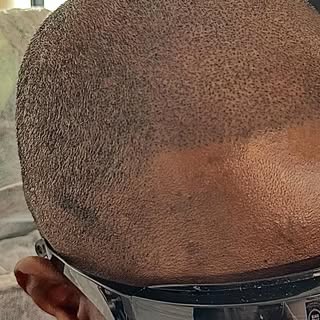 This is a first session #scalpmicropigmentation to reconstruct the #hairline and fill in the #bald s