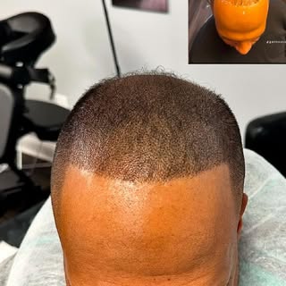 ✨ Unlock the Look of Fullness with Scalp Micropigmentation! ✨

Are you struggling with thinning hair