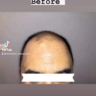 A handsome gentleman with type 6 hair loss underwent hair transplantation.
#aesthetic #cosmeticsurge
