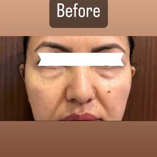 Wonderful lady with brow ptosis and lower eyelid bags with mid-face aging underwent browpexy,lower b