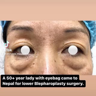 #aesthetics #aestheticsurgery #cosmeticrepairs #cosmeticsurgery #eyebags #blepharoplasty #nepal #fyp