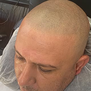 #hairlosssolutions #perfectbrows #finehair #rattail #hairclinic #hairloss #hairlosssolution #scalppi