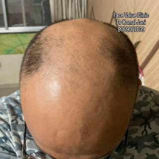 #drkomaljani #facevalueskinclinic #hairregrowthtreatment #hairlosssolution #hairgfc #hairline #hairt