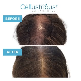 Explore the stunning transformations with our non-invasive hair loss solutions. 🌟 Achieve fuller, h