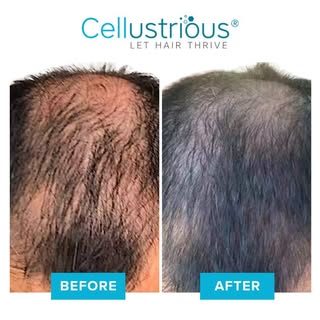 Check the amazing before and after results of our non-invasive hair loss treatments. 🌟 Embrace a fu