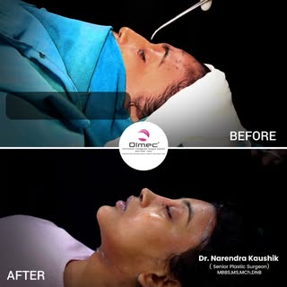 A Life-Changing Transformation ✨
Revision Forehead Feminization (Type K) and Revision Feminizing Rhi