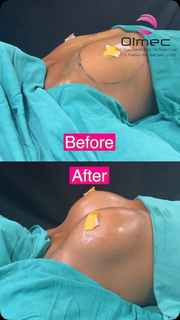 ✨ A Transformation That Speaks for Itself! ✨

A beautiful breast transformation designed to enhance 